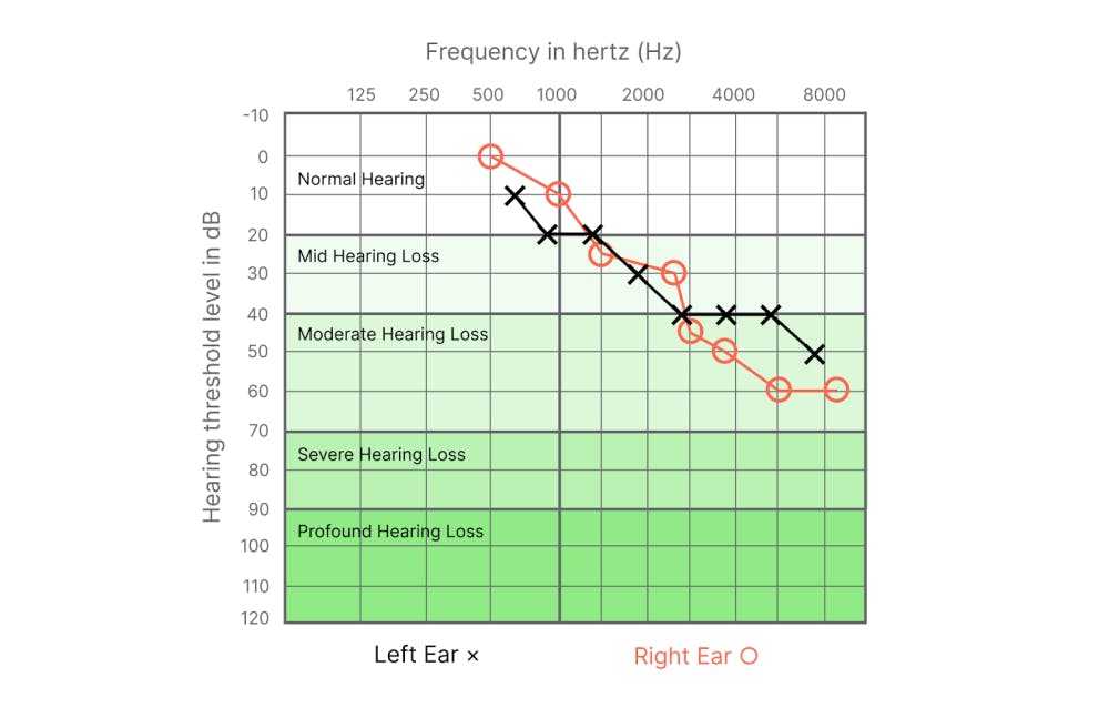 An audiogram chart illustrating hearing threshold levels across frequencies for the left and right ears. The graph uses colored regions to indicate normal hearing, mild, moderate, severe, and profound hearing loss categories.